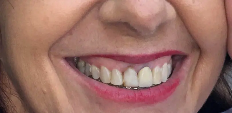 Antes